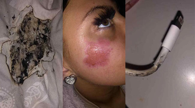 Thiếu nữ bỏng mặt vì điện thoại iPhone đang sạc phát nổ trong đêm